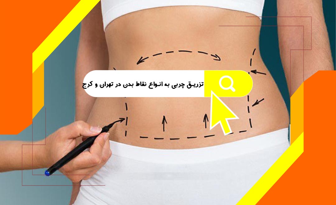 تزریق چربی به انواع نقاط بدن در تهران و کرج