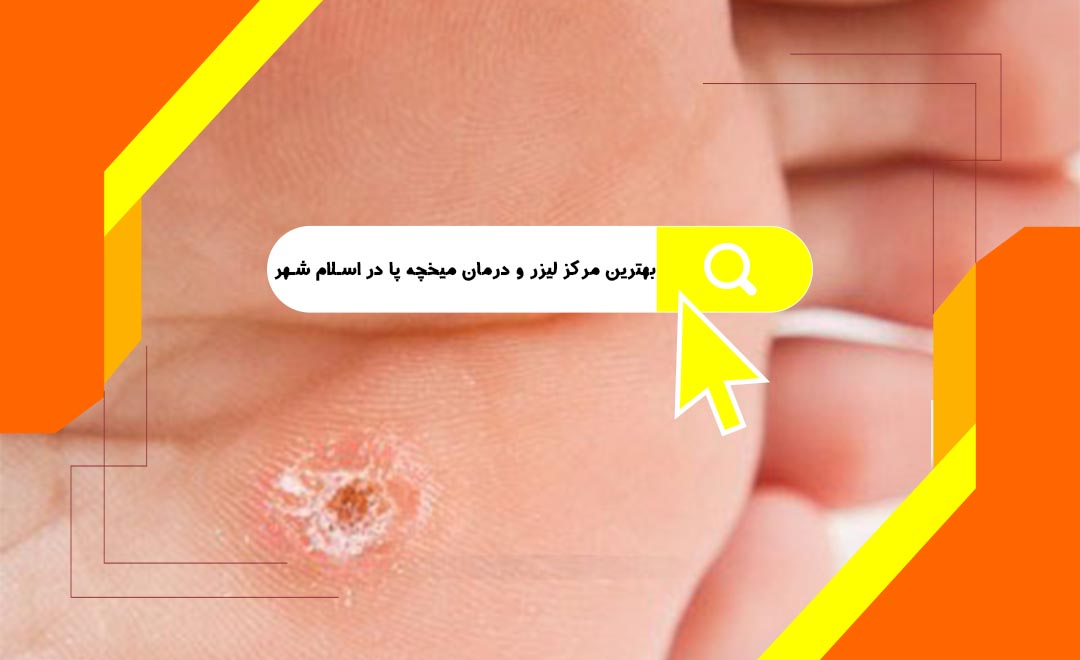 بهترین مرکز لیزر و درمان میخچه پا در اسلامشهر