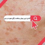 آسان ترین روش برداشت زگیل صورت و بدن در تهران و کرج ، عکس زیگیل سرطانی